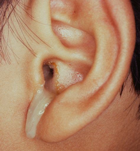 Gross Otorrhea In Chronic Suppurative Otitis Media Csom Senses