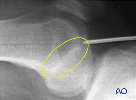 Retrograde Nailing Approach To The Femoral Shaft