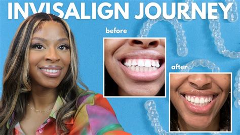 My Invisalign Journey Finished Treatment Things To Know Youtube