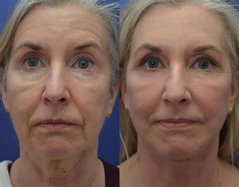 Patient 122581145 Facelift Gallery Tansavatdi Cosmetic