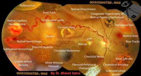 Retinal Diseases Signs In One Picture Eye Health Facts Optometry
