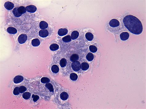 Benign Nodular Hyperplasia Of The Thyroid