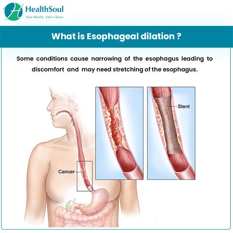 Esophageal Dilation Indications And Complications Healthsoul