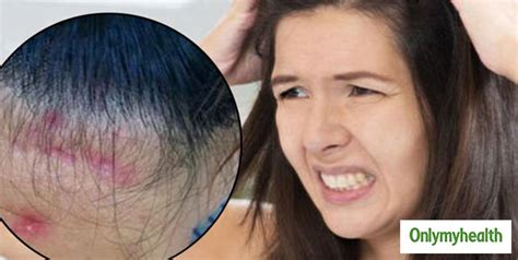 Do You Have Acne On Scalp Know The 5 Main Causes Of Scalp Acne
