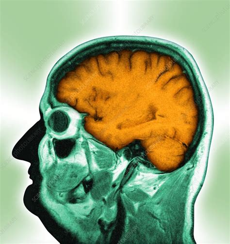 Normal Brain Mri Scan Stock Image F0012117 Science Photo Library
