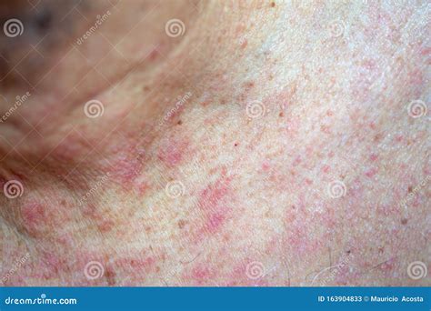 Atocpic Dermatitis Symptoms On The Right Shoulder Stock Image