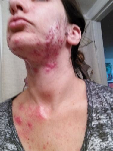 Severe Cystic Acne After Pregnancy And Birth Hormonal Acne By Katie27 Community