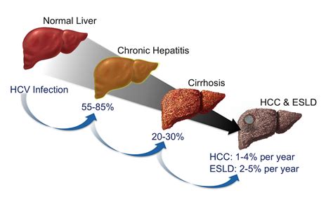 The Stages And Symptoms Of Hepatitis C Along With Its Treatment And