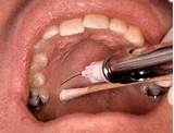 Local Anesthesia Used In Dentistry Images