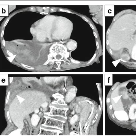 Radiographic Images Of The Adult Right Sided Bochdalek Hernia Prior To