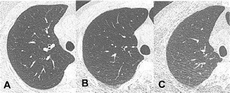 Figure 1 From Ultra Low Dose CT Of The Thorax Using Iterative