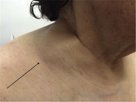 Pink The Basin Swelling Or Lumps Around Your Collarbone