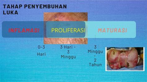 Mengobati Luka Bakar Tahap Penyembuhan Luka Bakar Youtube