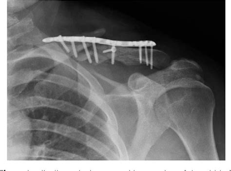 Figure 1 From Acromial Vascularized Graft Pedicled On The Acromial