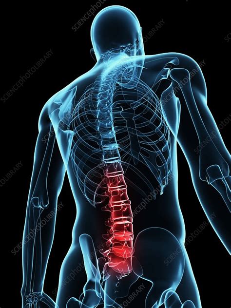 Back Pain Conceptual Artwork Stock Image F0041204 Science Photo