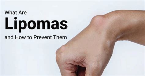 What Are Lipomas And How To Prevent Them