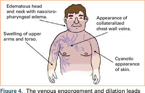 Figure 4 From Anesthetic Implications Of Superior Vena Cava Syndrome In