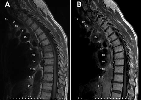 Missed T Spine Osteomyelitis The Role Of 18f Fdg Petct In The