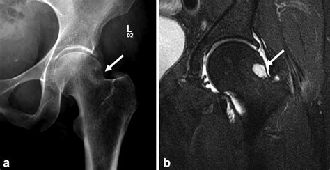 Mri Shoulder Impingement Syndrome