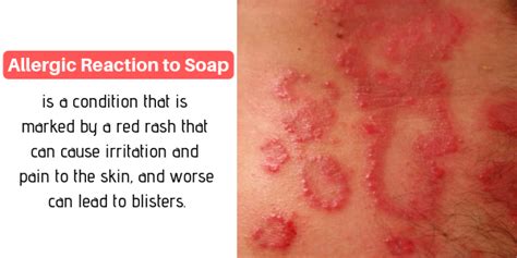 4 Allergens In Soap That Lead To Dermatitis Dermatitis Allergic Dermatitis Soap For