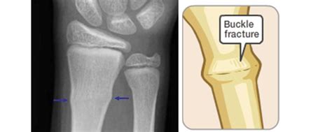 How To Care For Your Child With Buckle Fracture Sidra Medicine