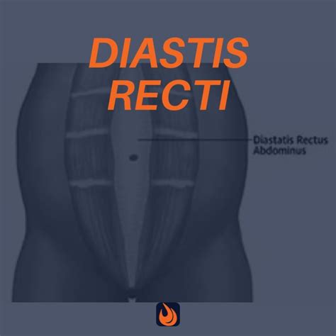 Diastasis Recti Can Hurt Anyone What Effective Personal Trainers Need