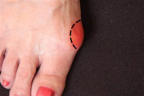 Minimally Invasive Bunion Surgery Benefits And Recovery Best Foot
