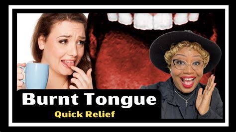 Burnt Tongue Remedy For Fast Relief Youtube