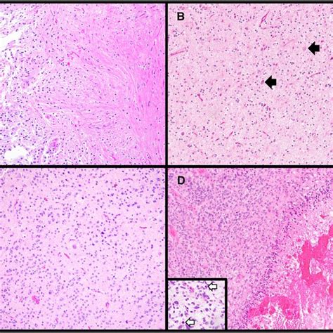 Varied Histologic Features Of Central Nervous System Tumors A