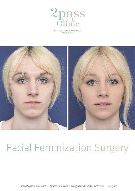 Male Into Female Facial Feminization Telegraph