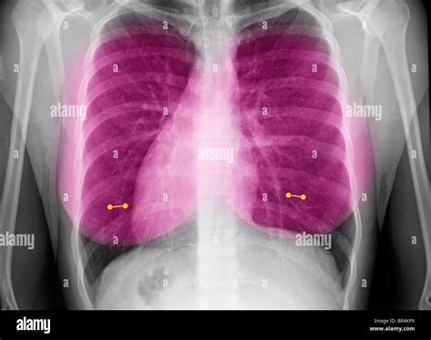 X Ray Mostrando Pezón Piercings En Una Mujer Joven Radiografía De