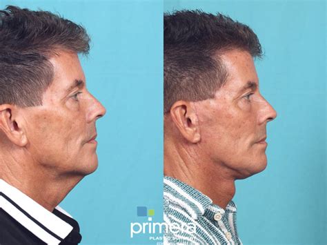 Neck Lift Before And After Pictures Case 842 Orlando Florida Primera Plastic Surgery