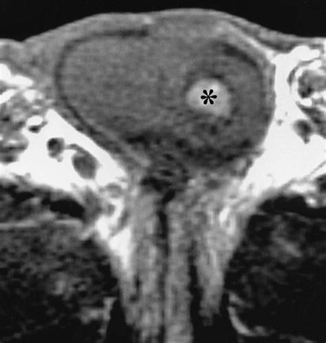 Mr Imaging Of Acute Penile Fracture Radiographics