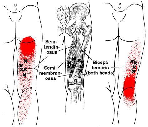 Since their muscle mass is not located in the pelvic area, but on the thigh, they are. Semimembranosus | The Trigger Point & Referred Pain Guide