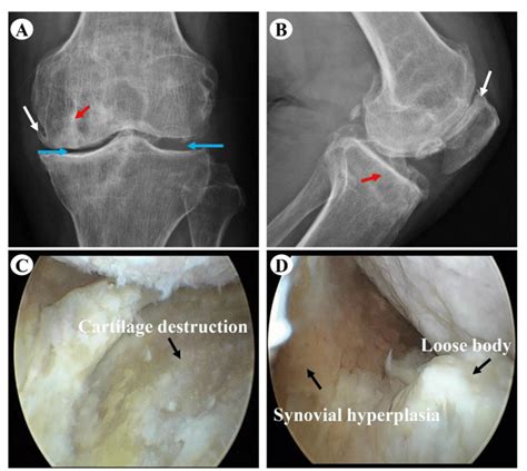 Radiographs And Arthroscopy Of Osteoarthritis A And B Are