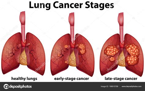 Lung cancer in dogs, symptoms & treatment options. Diagram showing lung cancer stages — Stock Vector ...