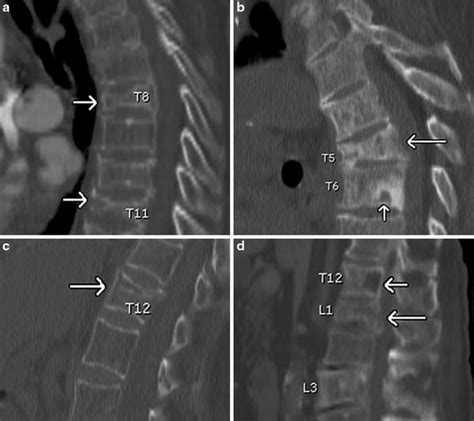 Types Of Vertebral Fractures Radiology Design Talk