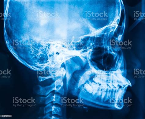 Xray Picture Of The Skull Stock Photo Download Image Now Patient X