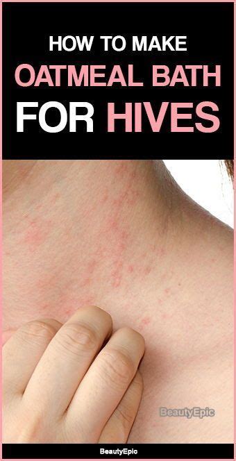 Oatmeal Bath Remedy For Hives How To Use Hives Remedies Remedies