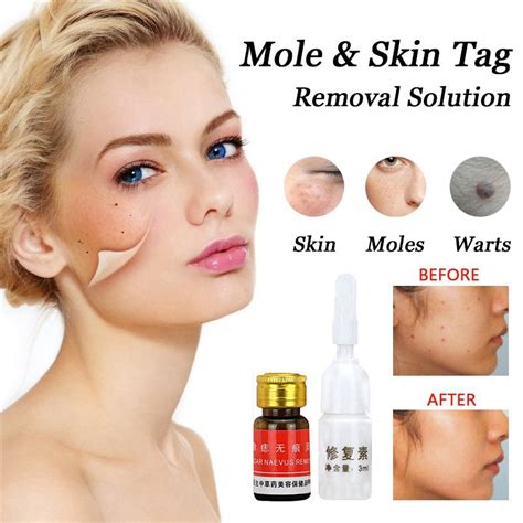 Dr Issei Speckle Killer And Wart Skin Tag Remover Chikabellas