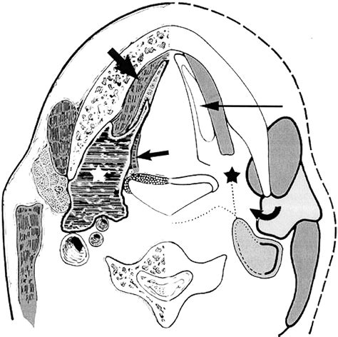 Giant Ranula Of The Neck Differentiation From Cystic Hygroma