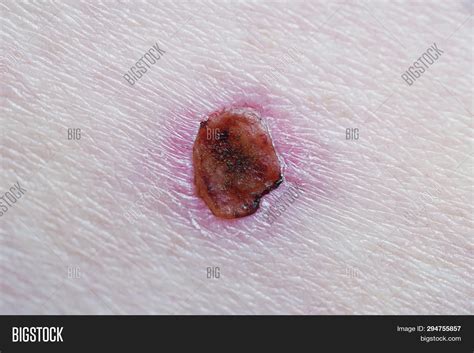 Healing Wound Scab Image And Photo Free Trial Bigstock