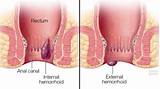 Pictures of Which Doctor Do You See For Hemorrhoids