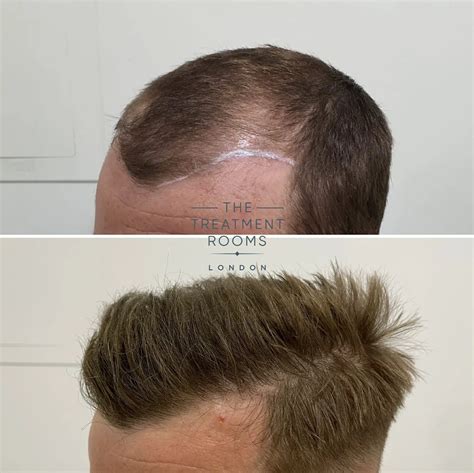 Temple Hair Loss Temple Hair Transplant Treatment Rooms London