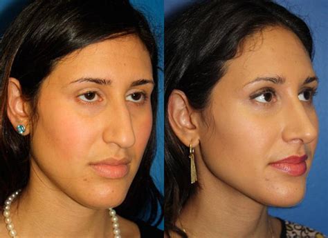 Middle Eastern Rhinoplasty New York City Ny Dr Philip Miller