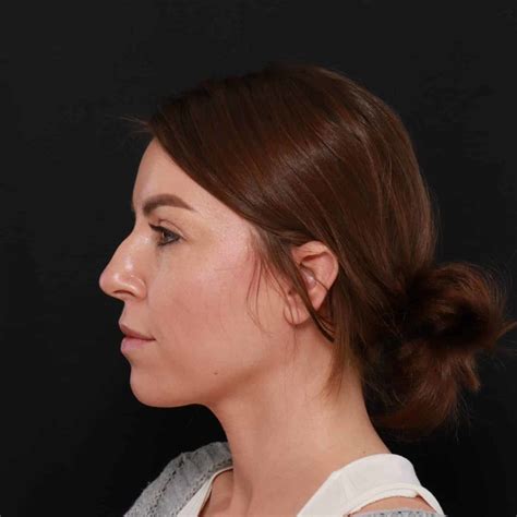 Rhinoplasty By Dr Henstrom Utah Facial Plastics