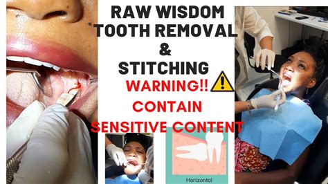 Painless Wisdom Tooth Removal Procedure Local Anaesthetic And Stitches