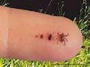 What kills seed ticks on your body?
