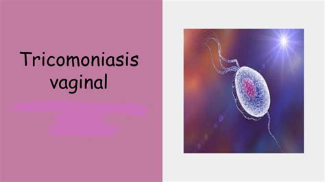 Tricomoniasis Vaginal Monica A Udocz