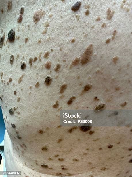 Seborrheic Keratosis On Human Skin Stock Photo Download Image Now